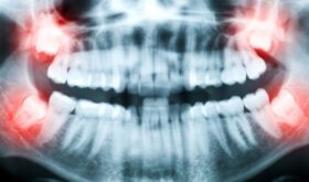 Стоматологическая процедура — кюретаж пародонтального кармана